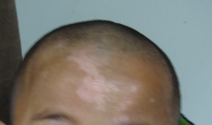 简述白癜风可以自愈吗